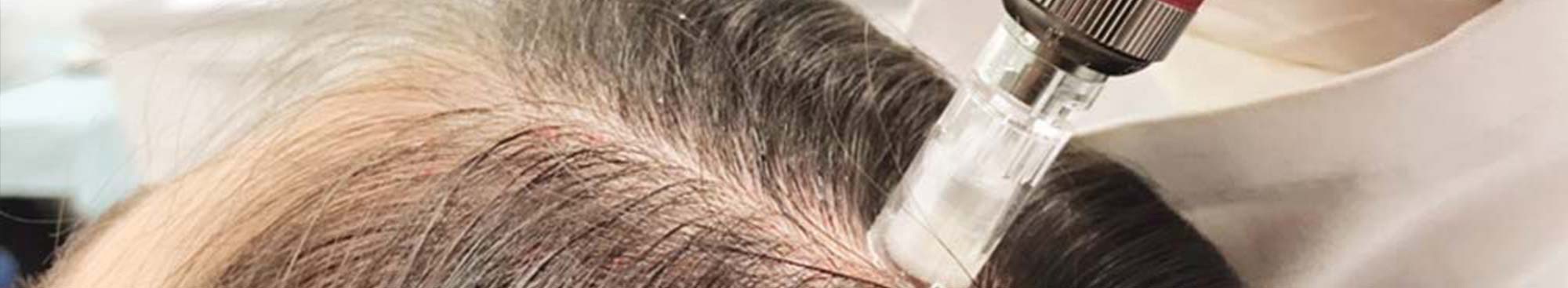 Microagulhamento Capilar - Microneedling Capilar Microagulhamento Capilar - Microneedling Capilar